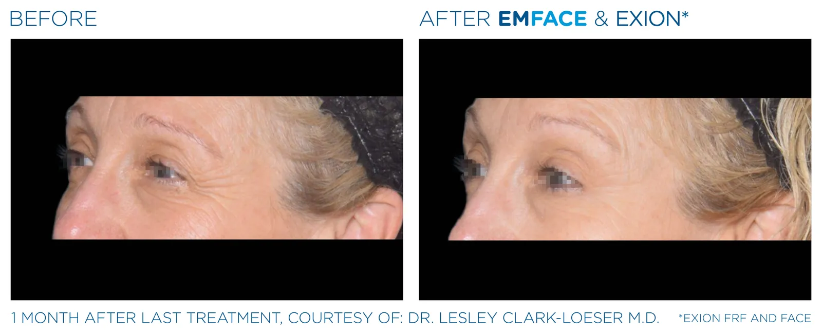 EMFACE before and after result 1