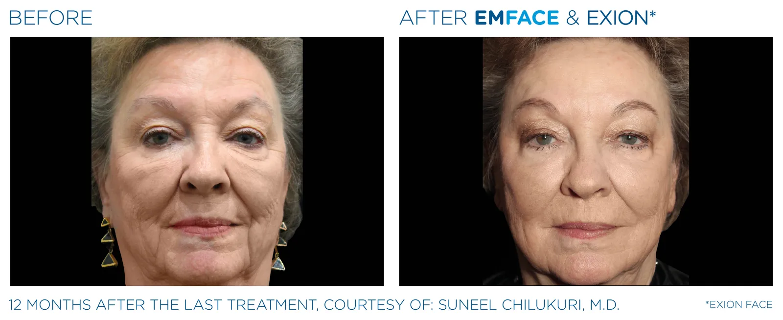 EMFACE before and after result 2