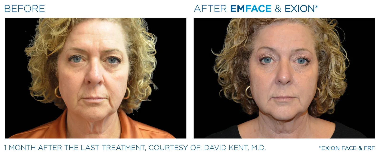 EMFACE before and after result 3