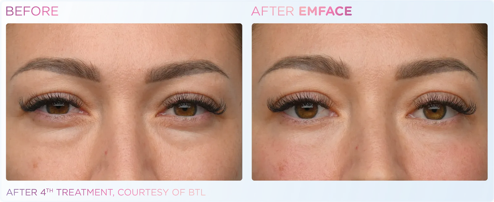 EMFACE before and after result 4
