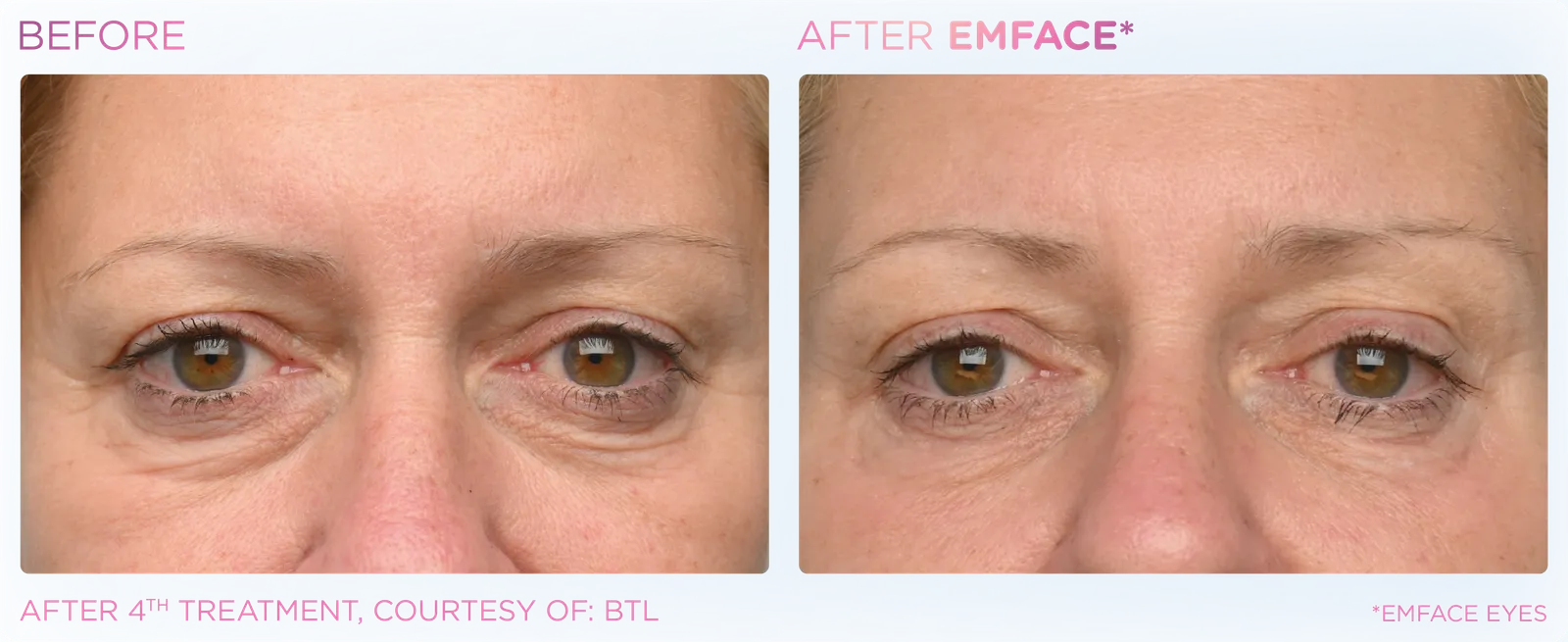 EMFACE before and after result 5