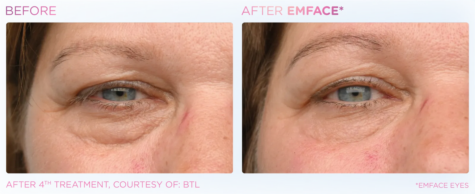 EMFACE before and after result 6
