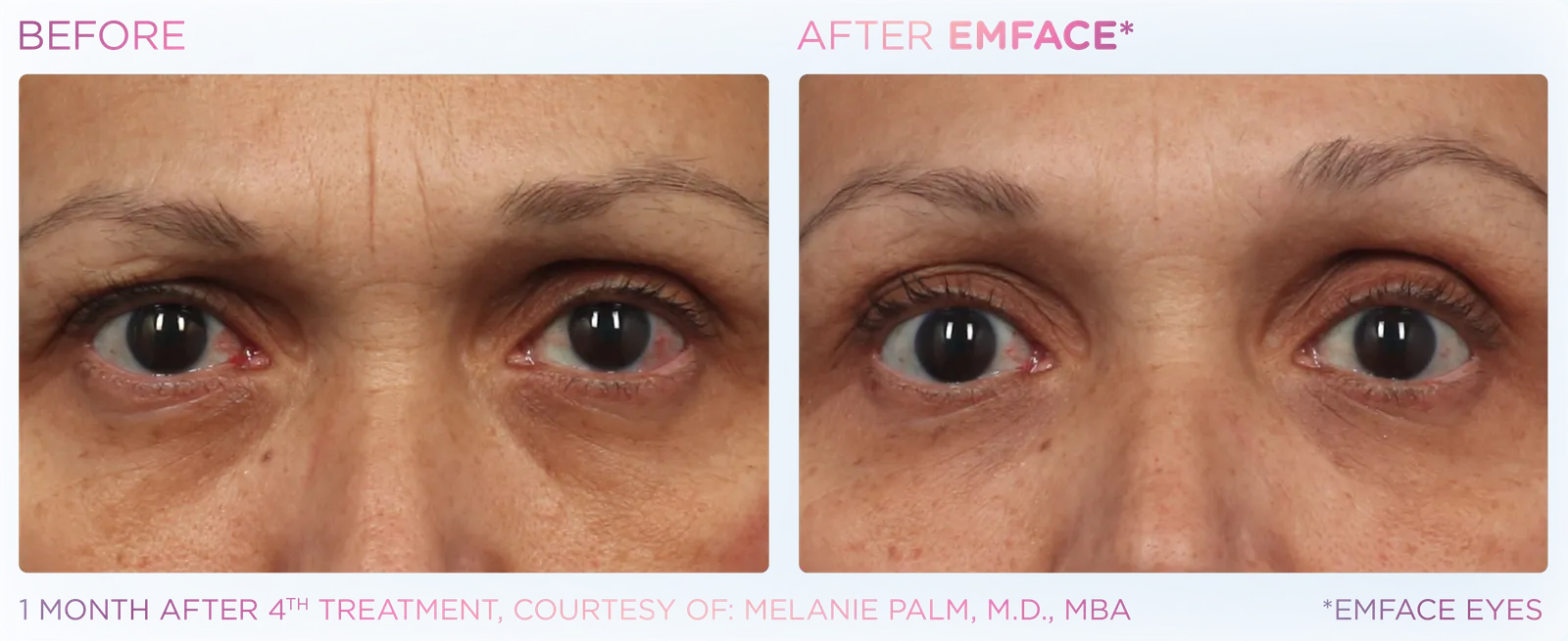 EMFACE before and after result 7