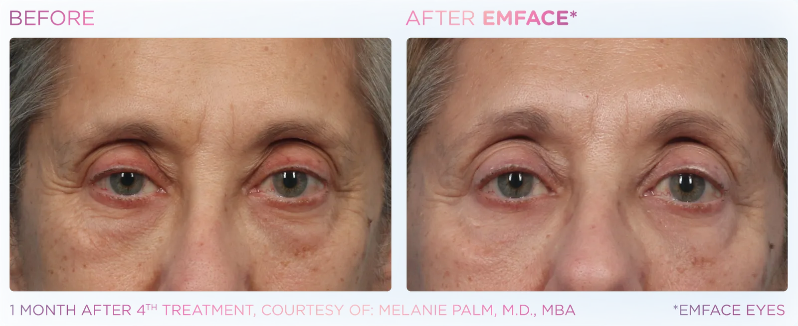 EMFACE before and after result 8