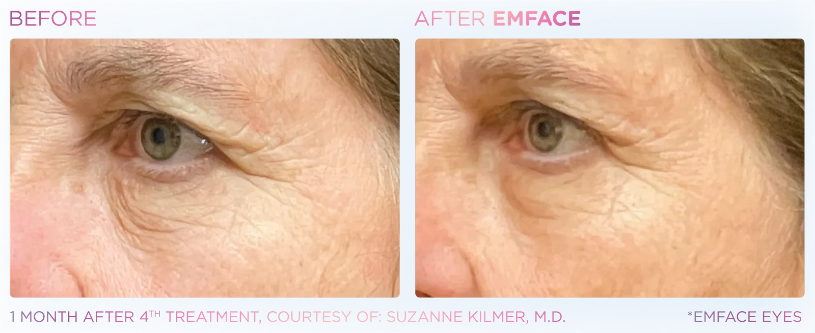 EMFACE before and after result 9