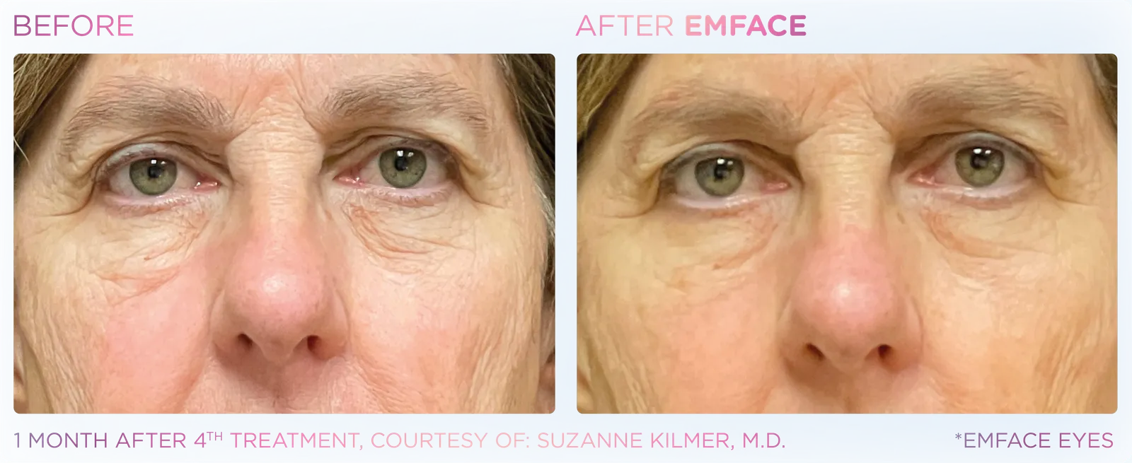EMFACE before and after result 10