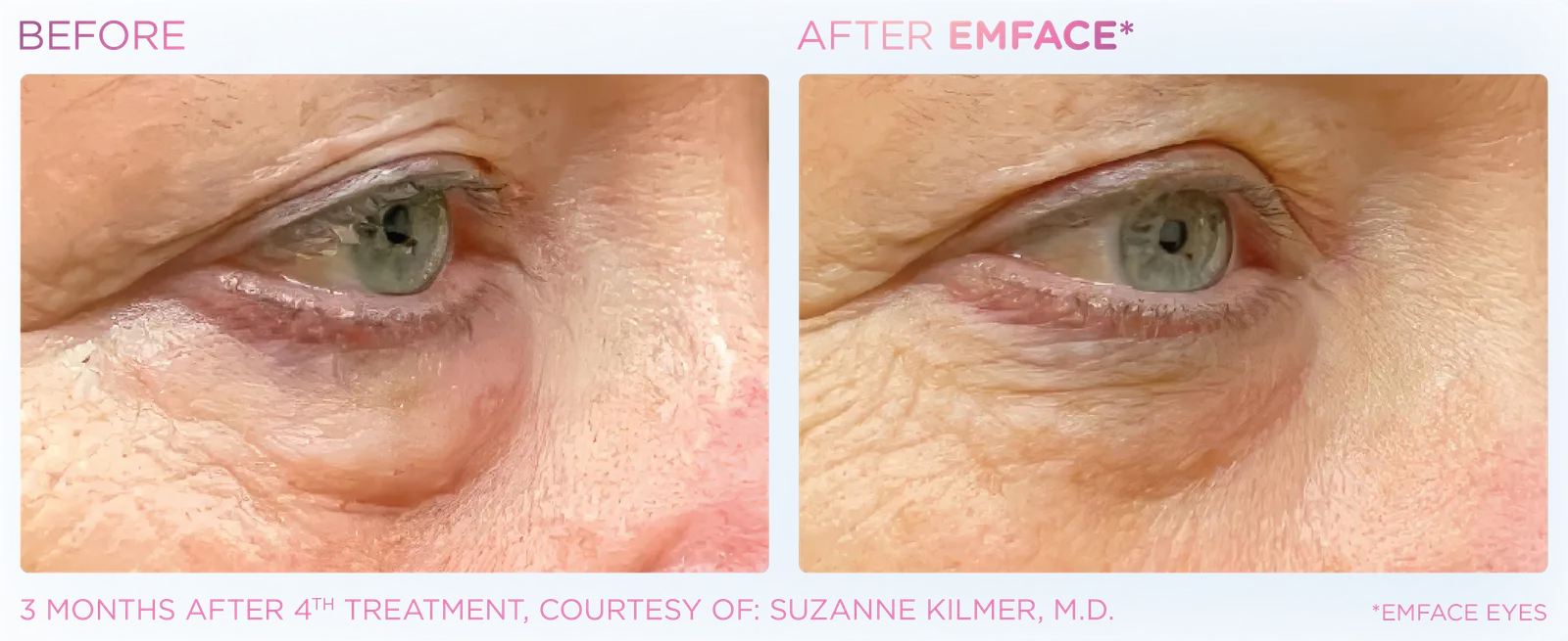 EMFACE before and after result 11