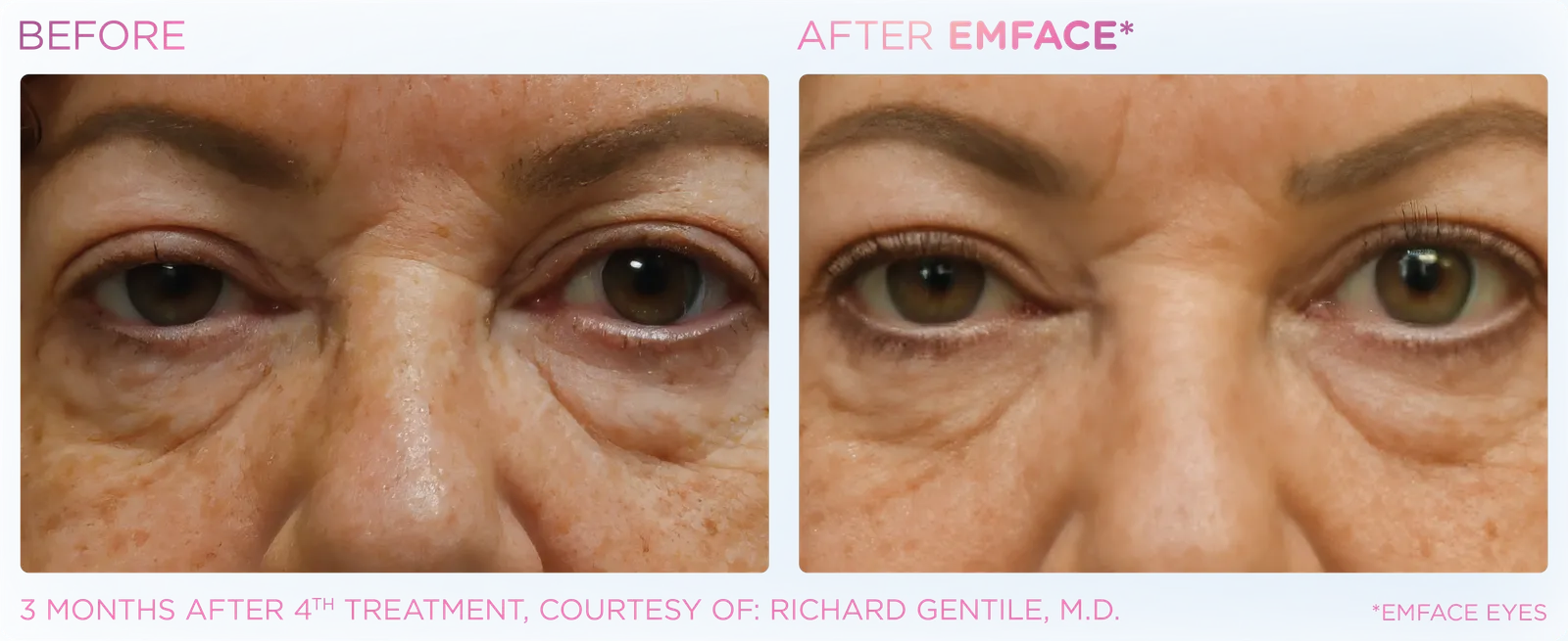 EMFACE before and after result 12
