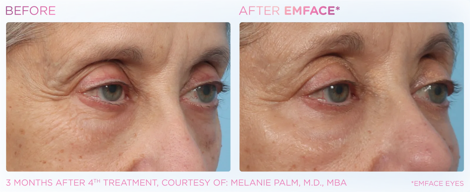 EMFACE before and after result 13