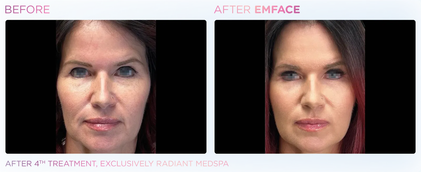 EMFACE before and after result 14