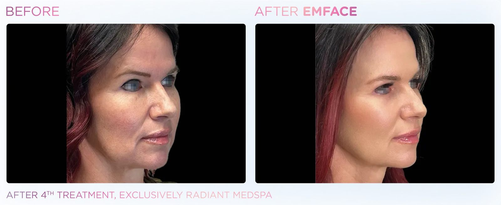 EMFACE before and after result 15