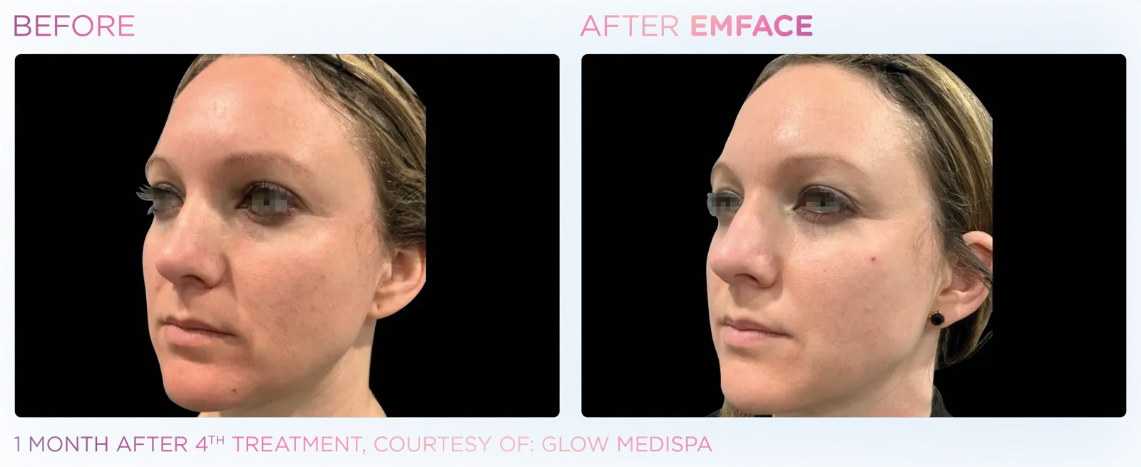 EMFACE before and after result 16
