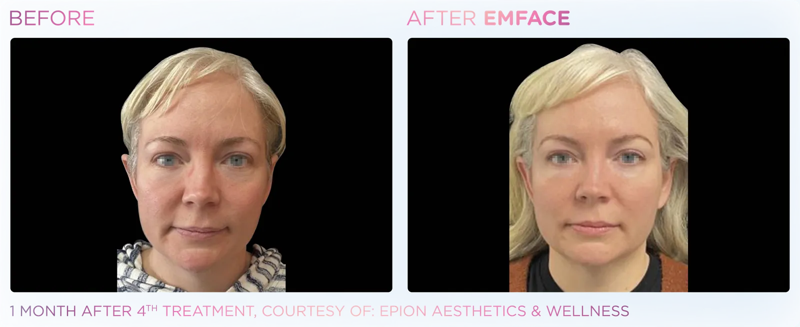 EMFACE before and after result 17