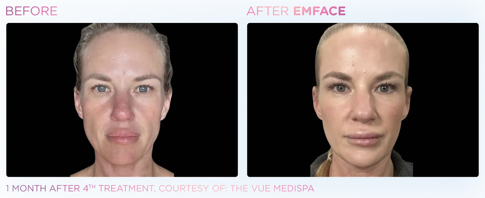 EMFACE before and after result 18