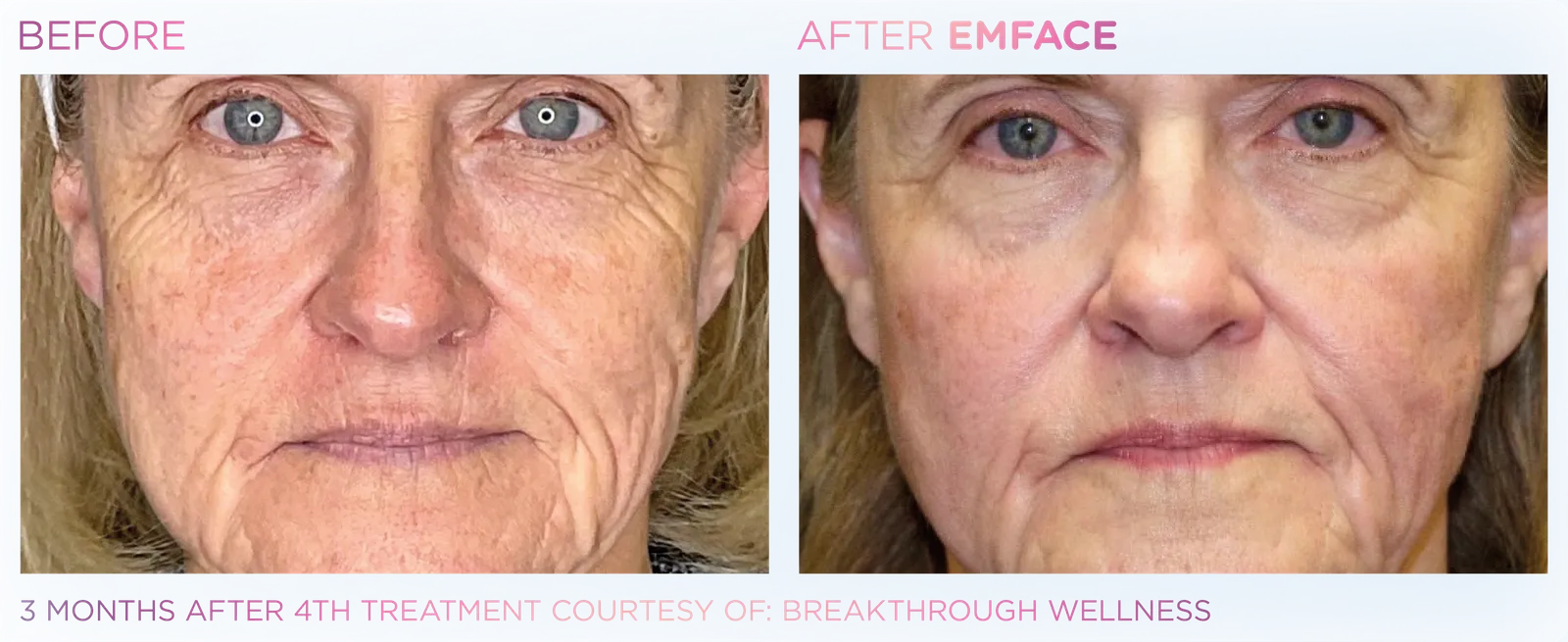 EMFACE before and after result 19
