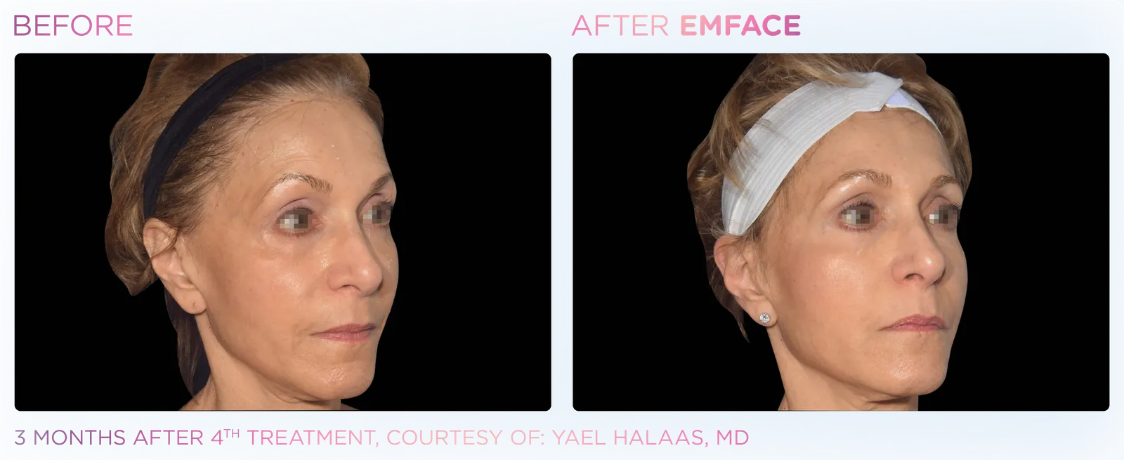 EMFACE before and after result 20