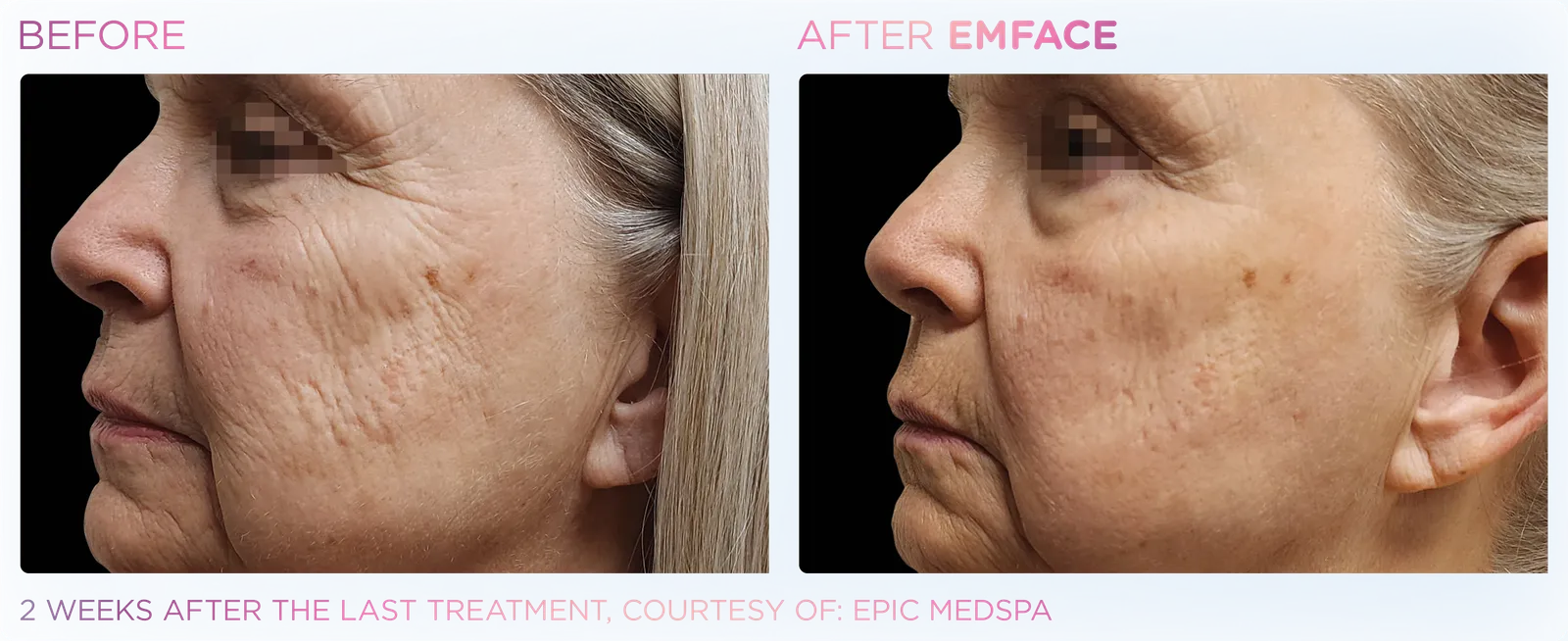 EMFACE before and after result 21