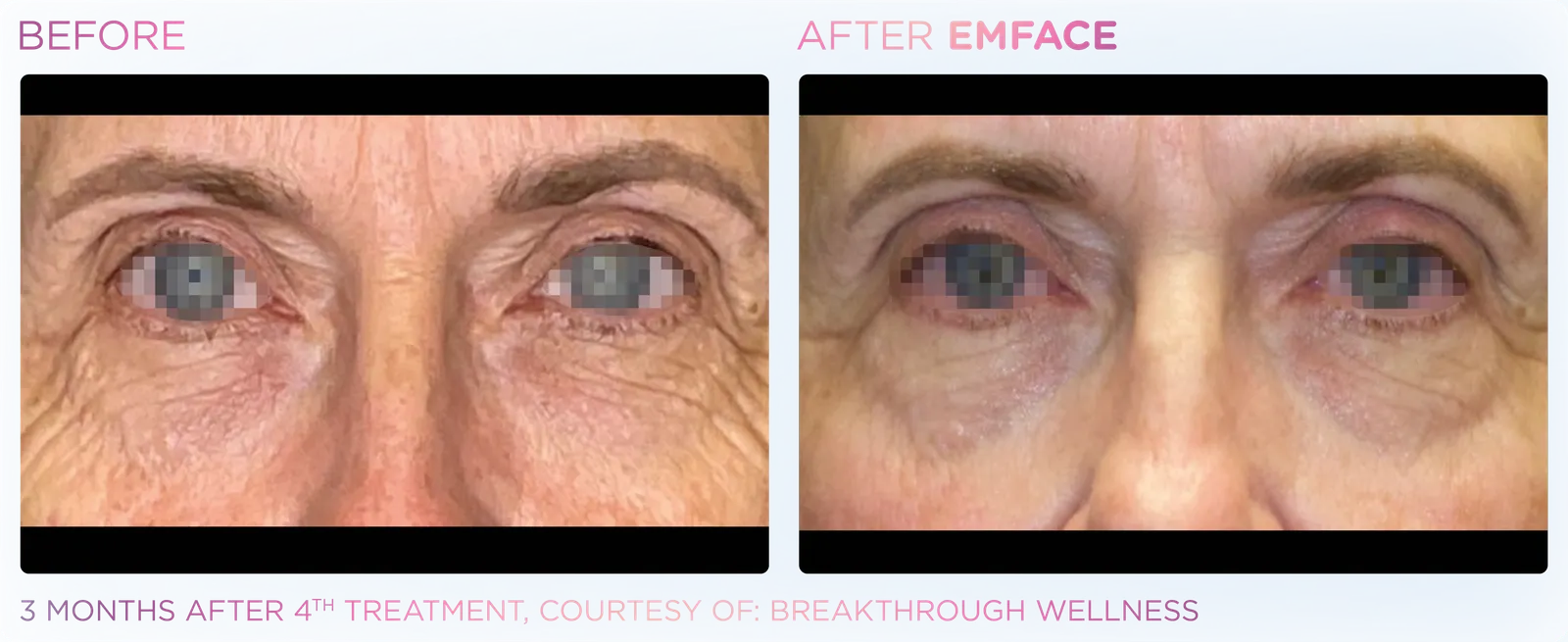 EMFACE before and after result 22